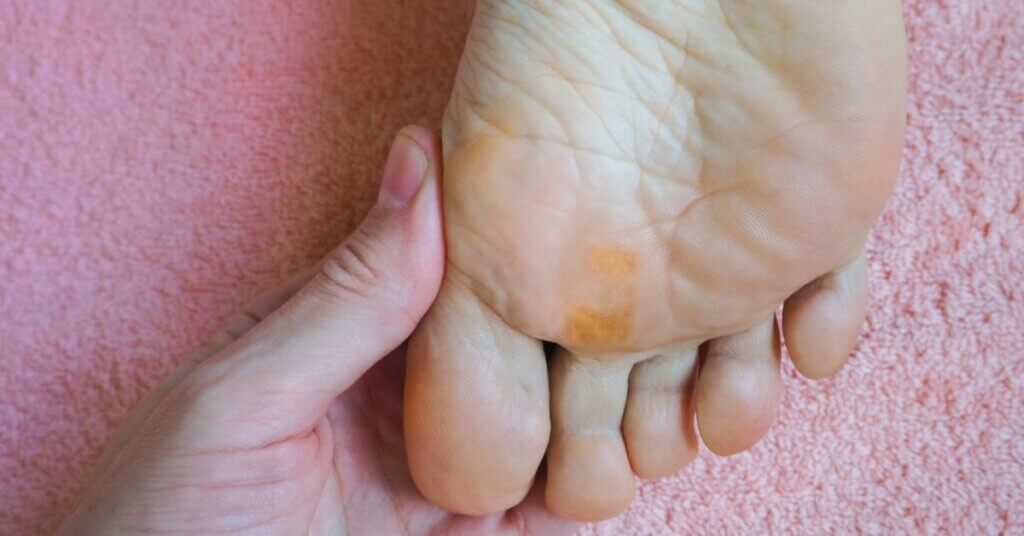 Eelt op je voeten? De 6