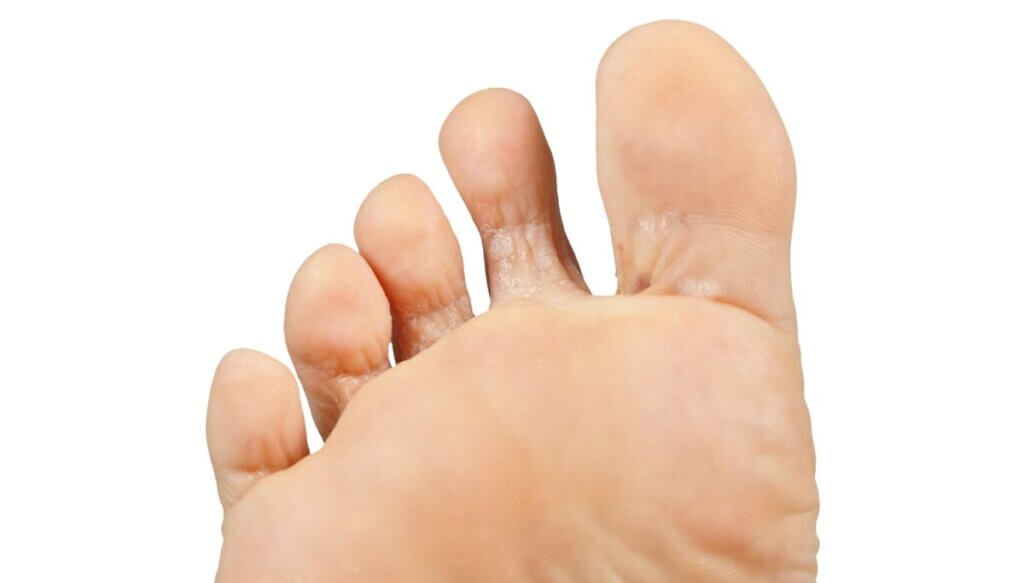 Ringworm 5 geheime tips om het te behandelen.