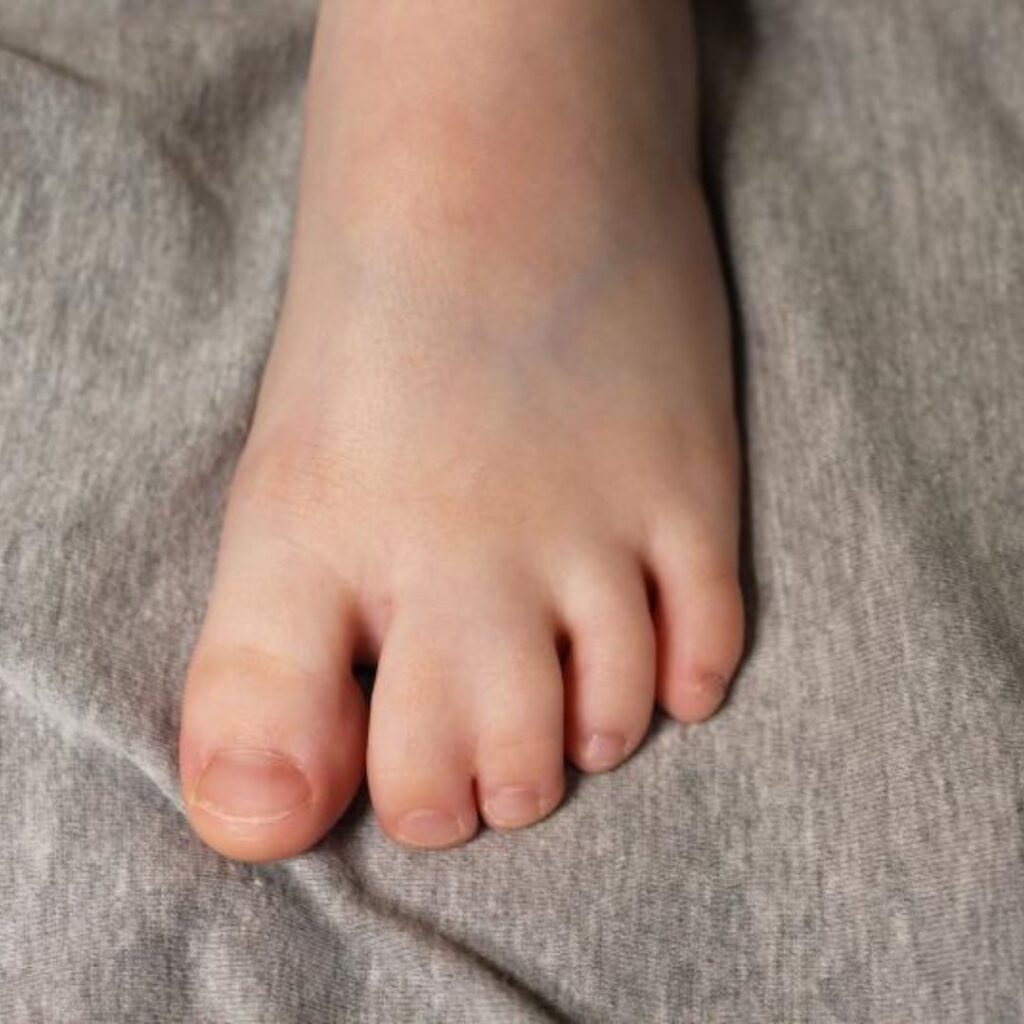 Syndactylie syndactylie