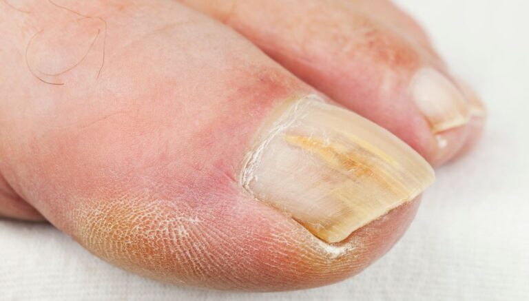 Geribbelde nagels